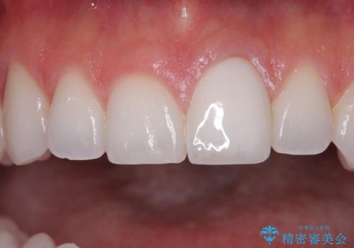 ぶつけて変色した前歯 オールセラミッククラウン治療の治療後