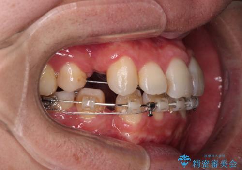 顎が左右にずれた咬み合わせ ハーフリンガルの抜歯矯正の治療中