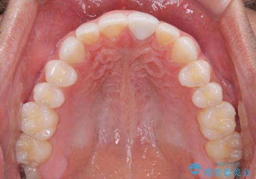 ぶつけて変色した前歯 オールセラミッククラウン治療の治療後