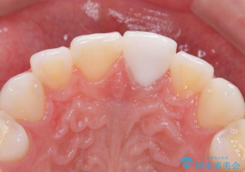 ぶつけて変色した前歯 オールセラミッククラウン治療の治療後