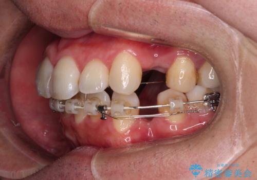 顎が左右にずれた咬み合わせ ハーフリンガルの抜歯矯正の治療中