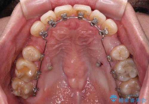 顎が左右にずれた咬み合わせ ハーフリンガルの抜歯矯正の治療中