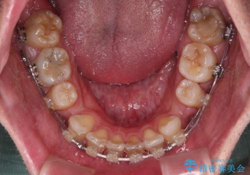 顎が左右にずれた咬み合わせ ハーフリンガルの抜歯矯正の治療中