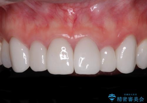 気にしていた歯並びをインビザラインで改善 セラミックも作り替えて綺麗な口元にの治療前