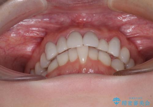 気にしていた歯並びをインビザラインで改善 セラミックも作り替えて綺麗な口元にの治療前