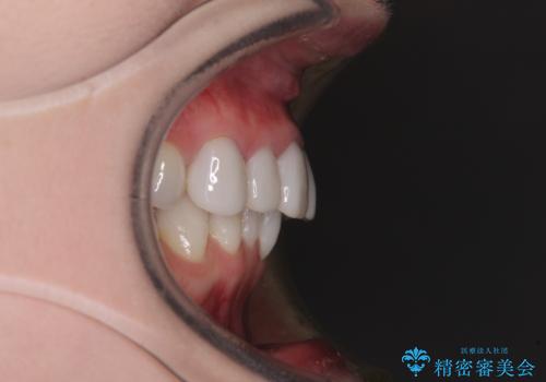気にしていた歯並びをインビザラインで改善 セラミックも作り替えて綺麗な口元にの治療前
