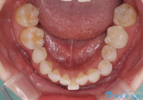 気にしていた歯並びをインビザラインで改善　セラミックも作り替えて綺麗な口元にの治療前