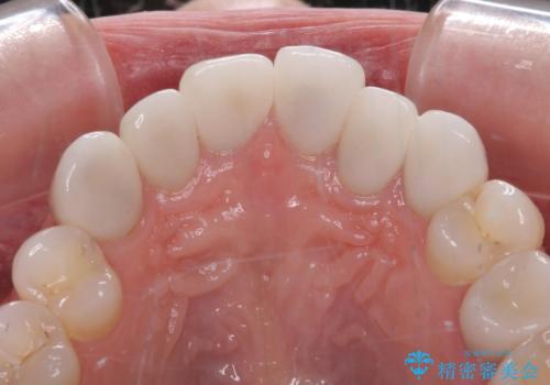 気にしていた歯並びをインビザラインで改善 セラミックも作り替えて綺麗な口元にの治療前