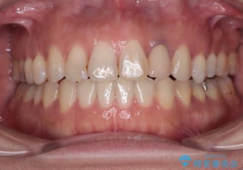 開咬と変色した前歯　インビザライン矯正とオールセラミッククラウン治療