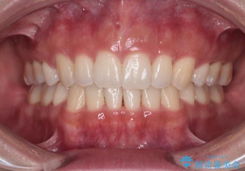 閉じにくい口元をワイヤー抜歯矯正でスッキリした口元に