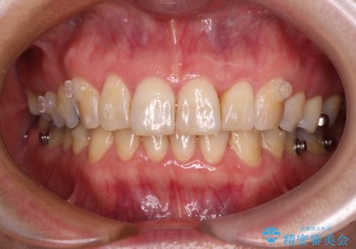 インビザラインが続けられない 忍耐のマウスピース矯正の治療中