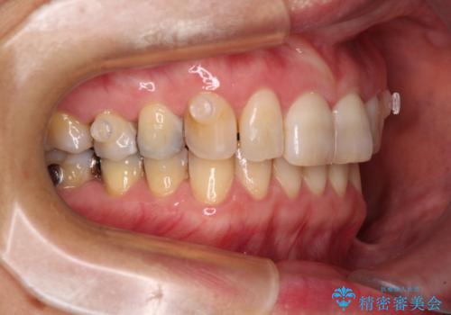 インビザラインが続けられない 忍耐のマウスピース矯正の治療中