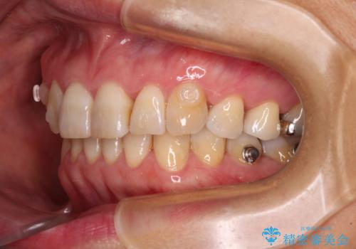 インビザラインが続けられない 忍耐のマウスピース矯正の治療中