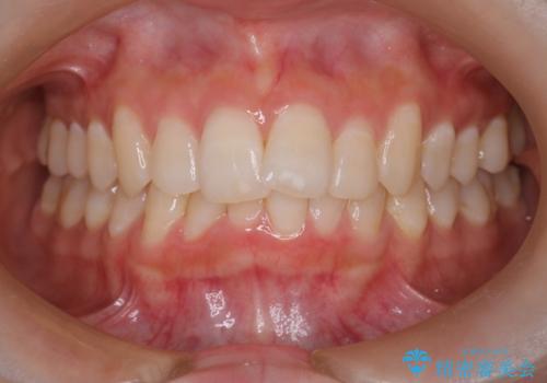 透明なマウスピースで前歯のガタツキを改善の治療前