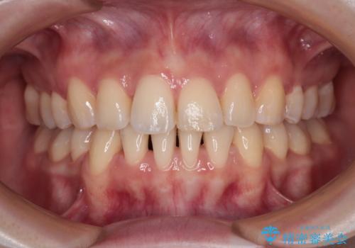 【モニター】飛び出した上顎前歯を抜歯矯正で引っ込める ワイヤー装置の抜歯矯正治療の治療後