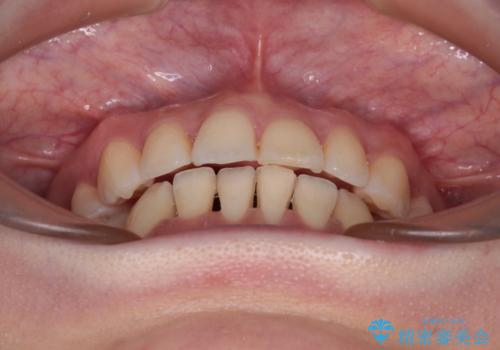 【モニター】飛び出した上顎前歯を抜歯矯正で引っ込める ワイヤー装置の抜歯矯正治療の治療後