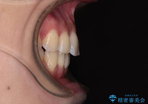 【モニター】飛び出した上顎前歯を抜歯矯正で引っ込める ワイヤー装置の抜歯矯正治療の治療後