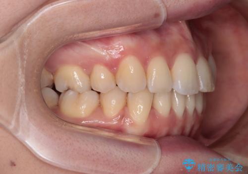 【モニター】飛び出した上顎前歯を抜歯矯正で引っ込める ワイヤー装置の抜歯矯正治療の治療後