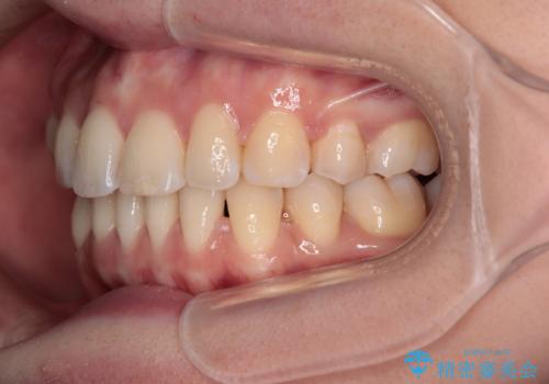 【モニター】飛び出した上顎前歯を抜歯矯正で引っ込める ワイヤー装置の抜歯矯正治療の治療後