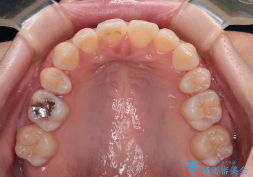 【モニター】飛び出した上顎前歯を抜歯矯正で引っ込める ワイヤー装置の抜歯矯正治療の治療後