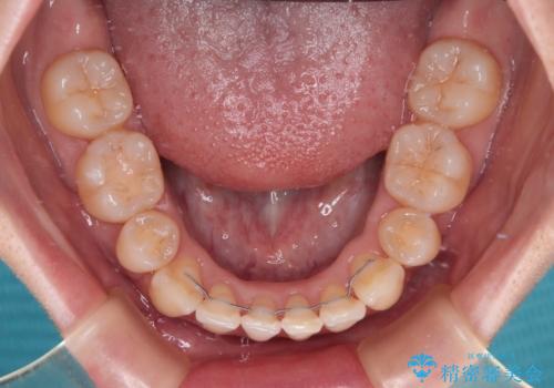 【モニター】飛び出した上顎前歯を抜歯矯正で引っ込める ワイヤー装置の抜歯矯正治療の治療後