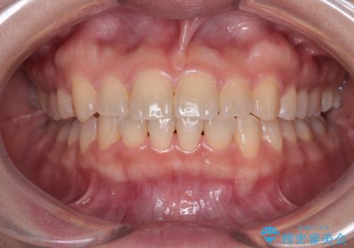 八重歯を治す　非抜歯のワイヤー矯正治療
