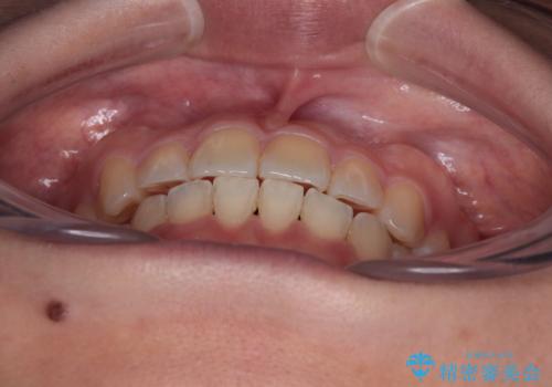 八重歯を治す 非抜歯のワイヤー矯正治療の治療後