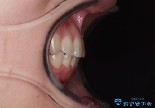 八重歯を治す 非抜歯のワイヤー矯正治療の治療後