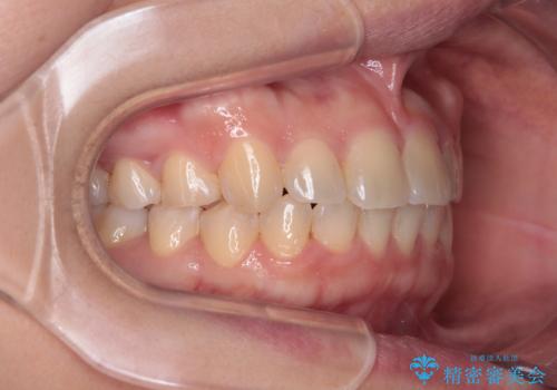 八重歯を治す 非抜歯のワイヤー矯正治療の治療後