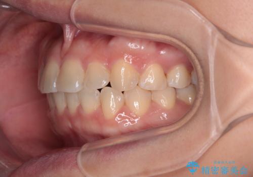 八重歯を治す 非抜歯のワイヤー矯正治療の治療後