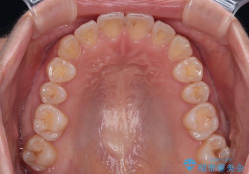 八重歯を治す 非抜歯のワイヤー矯正治療の治療後