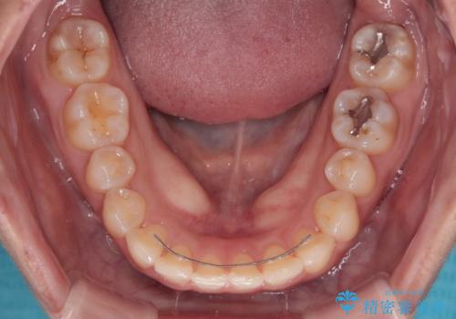 八重歯を治す　非抜歯のワイヤー矯正治療の治療後