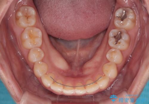 八重歯を治す 非抜歯のワイヤー矯正治療の治療後