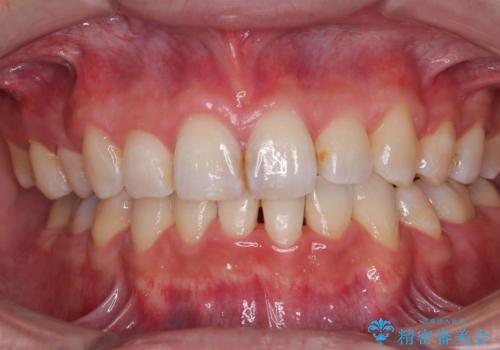 顎が左右にずれた咬み合わせ ハーフリンガルの抜歯矯正