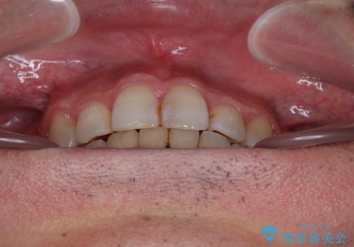 顎が左右にずれた咬み合わせ ハーフリンガルの抜歯矯正の治療後