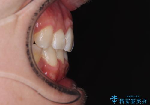 顎が左右にずれた咬み合わせ ハーフリンガルの抜歯矯正の治療後