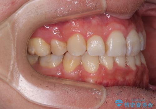 顎が左右にずれた咬み合わせ ハーフリンガルの抜歯矯正の治療後