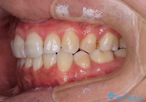 顎が左右にずれた咬み合わせ ハーフリンガルの抜歯矯正の治療後