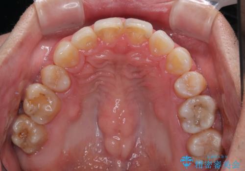 顎が左右にずれた咬み合わせ ハーフリンガルの抜歯矯正の治療後