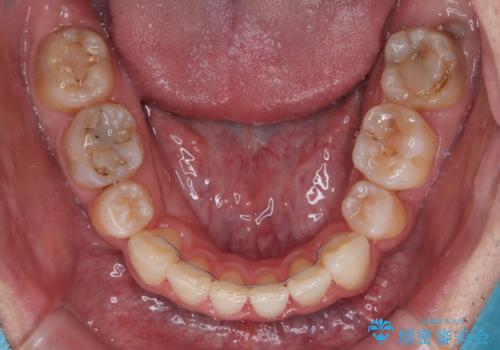 顎が左右にずれた咬み合わせ ハーフリンガルの抜歯矯正の治療後
