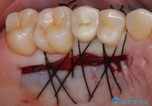 歯根が露出している歯の歯肉移植　根面被覆術の治療中