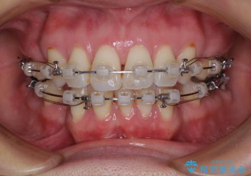 前方に飛び出した前歯 ワイヤー装置での抜歯矯正の治療中