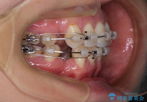 前方に飛び出した前歯　ワイヤー装置での抜歯矯正の治療中
