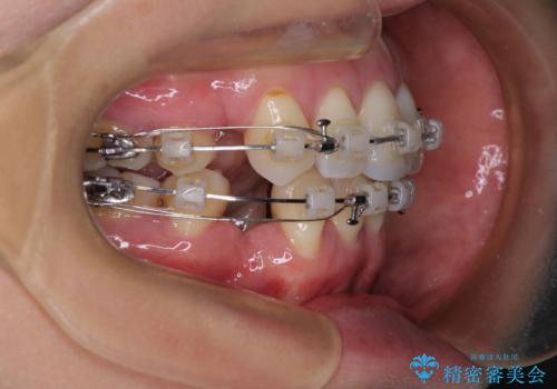 前方に飛び出した前歯 ワイヤー装置での抜歯矯正の治療中