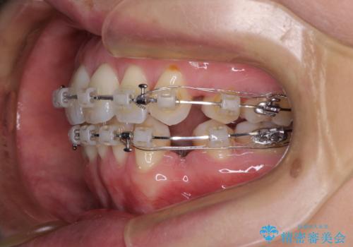 前方に飛び出した前歯　ワイヤー装置での抜歯矯正の治療中