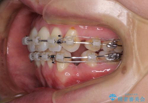 前方に飛び出した前歯 ワイヤー装置での抜歯矯正の治療中