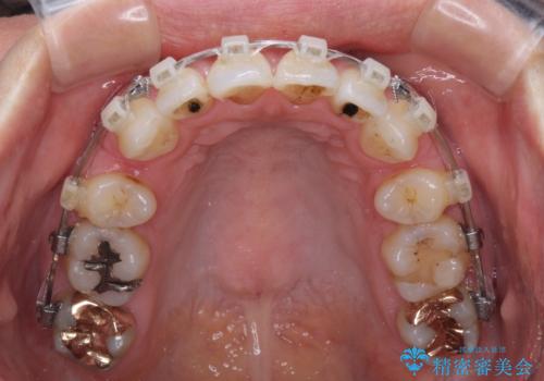 前方に飛び出した前歯 ワイヤー装置での抜歯矯正の治療中