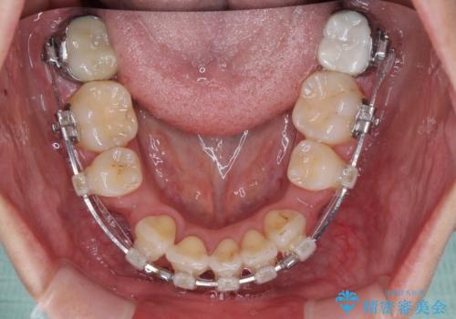 前方に飛び出した前歯　ワイヤー装置での抜歯矯正の治療中