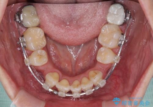前方に飛び出した前歯 ワイヤー装置での抜歯矯正の治療中