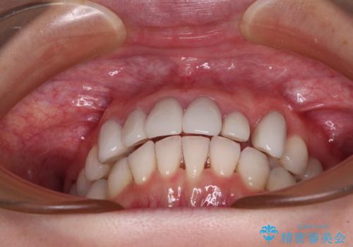 気にしていた歯並びをインビザラインで改善 セラミックも作り替えて綺麗な口元にの治療中